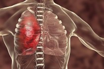 Neumonía condición inflamatoria del pulmón, ilustración digital
. - foto de stock
