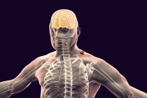 Menschliche Silhouette mit durch Zecken übertragener Gehirnentzündung, digitale Illustration. — Stockfoto