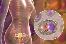 Digitale Illustration des weiblichen Fortpflanzungssystems und der Chlamydia trachomatis Bakterien, die eine Chlamydialinfektion verursachen. — Stockfoto