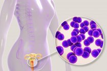 Nahaufnahme bakterieller Gonorrhoe-Infektion im weiblichen Körper, digitale Illustration. — Stockfoto