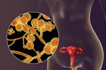 Illustration numérique montrant la vaginite causée par le champignon Candida albicans et le gros plan des cellules de levure . — Photo de stock