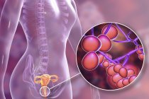 Digital illustration showing vaginitis caused by Candida albicans fungus and close-up of yeast cells. — Stock Photo