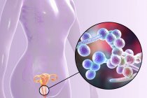 Illustration numérique montrant la vaginite causée par le champignon Candida albicans et le gros plan des cellules de levure
. — Photo de stock