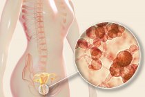Digitale Illustration, die Vaginitis durch Candida auris-Pilz und Nahaufnahme von Hefezellen zeigt. — Stockfoto