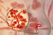 Цифрова ілюстрація, що показує вагініт, спричинений грибком Candida auris та крупним планом дріжджових клітин . — стокове фото