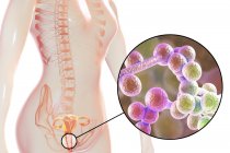 Digitale Illustration zeigt Vaginitis durch Candida albicans Pilz und Nahaufnahme von Hefezellen. — Stockfoto