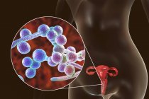 Ilustración digital que muestra vaginitis causada por hongo Candida albicans y primer plano de las células de levadura . - foto de stock