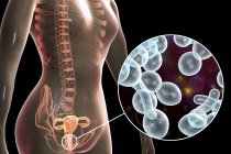 Цифрова ілюстрація, що показує вагініт, спричинений грибком Candida та крупним планом дріжджових клітин . — стокове фото