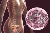 Weibliches Fortpflanzungssystem und Gardnerella vaginalis-Bakterien an vaginalen Epithelzellen, die bakterielle Vaginose verursachen, digitale Illustration. — Stockfoto