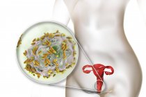 El sistema reproductor femenino y la bacteria Gardnerella vaginalis unidos a las células epiteliales vaginales que causan vaginosis bacteriana, ilustración digital . - foto de stock