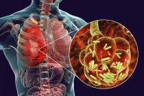 Illustration numérique des bactéries en forme de tige à l'intérieur des alvéoles pulmonaires causant une pneumonie
. — Photo de stock