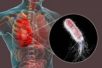 Пневмонія, викликані бактерія синьогнійна паличка, цифрова ілюстрація. — стокове фото