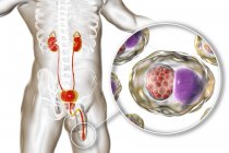 Ilustração digital da silhueta masculina com esfregaço uretral mostrando infecção Chlamydial com bactérias Chlamydia trachomatis . — Fotografia de Stock