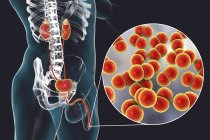 Primer plano de la infección por gonorrea bacteriana en el cuerpo masculino, ilustración digital
. - foto de stock