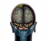 Жовта пухлина мозку на скануванні магнітно-резонансної томографії, ілюстрація . — стокове фото