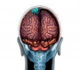 Синяя опухоль головного мозга на магнитно-резонансной томографии, иллюстрация . — стоковое фото