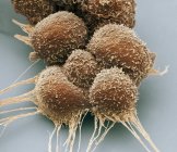 Cellules cancéreuses de la prostate, micrographie électronique à balayage coloré
. — Photo de stock