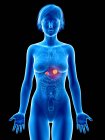 Ilustração médica do câncer de glândula adrenal na silhueta feminina . — Fotografia de Stock