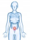 Медицинская иллюстрация рака толстой кишки в женском силуэте
. — стоковое фото