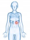 Медицинская иллюстрация рака почки в женском силуэте
. — стоковое фото