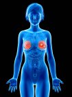 Медичні ілюстрація раку молочних залоз у жіночий силует. — стокове фото