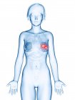 Медицинская иллюстрация рака молочных желез в женском силуэте
. — стоковое фото