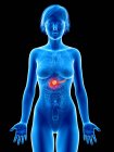 Медичні ілюстрація раку підшлункової залози в жіночий силует. — стокове фото