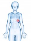 Ilustración médica del cáncer de bazo en la silueta femenina . - foto de stock