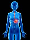 Illustration médicale du cancer de l'estomac en silhouette féminine . — Photo de stock
