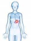 Illustrazione medica del cancro allo stomaco nella silhouette femminile . — Foto stock