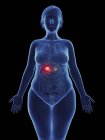 Иллюстрация раковой опухоли в женских надпочечниках . — стоковое фото