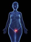 Ilustración de tumor canceroso en la vejiga femenina . - foto de stock