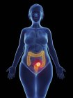 Illustration de tumeur cancéreuse dans le rectum féminin . — Photo de stock