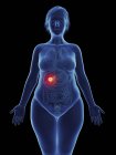 Ilustración de tumor canceroso en la vesícula biliar femenina . - foto de stock