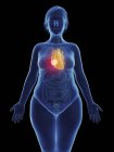 Иллюстрация раковой опухоли в женском сердце . — стоковое фото