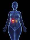 Ilustración de tumor canceroso en riñón femenino . - foto de stock