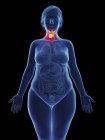 Ілюстрація ракової пухлини у жіночому гортані . — стокове фото