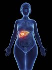 Illustration of cancerous tumour in female liver. — Stock Photo