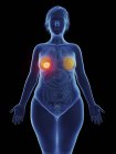 Иллюстрация раковой опухоли в женской груди . — стоковое фото