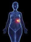 Ілюстрація ракової пухлини у жіночій селезінці . — стокове фото