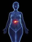 Ilustração do tumor canceroso no pâncreas feminino . — Fotografia de Stock