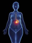 Illustrazione del tumore canceroso nello stomaco femminile . — Foto stock