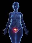 Ilustración de tumor canceroso en el útero femenino . - foto de stock