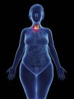 Ilustración de tumor canceroso en la glándula tiroides femenina . - foto de stock