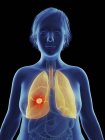 Illustration von Krebstumoren in der weiblichen Lunge. — Stockfoto