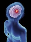 Ilustração do tumor canceroso no cérebro feminino . — Fotografia de Stock