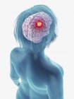 Illustration de tumeur cancéreuse dans le cerveau féminin . — Photo de stock