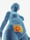 Иллюстрация раковой опухоли в женском тонком кишечнике . — стоковое фото