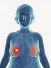 Illustration of cancerous tumour in female breast. — Stock Photo