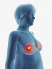 Illustration de tumeur cancéreuse dans les glandes mammaires féminines . — Photo de stock
